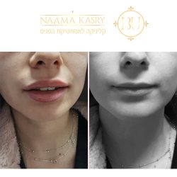 תמונות לפני ואחרי שפתיים